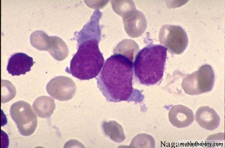 ACUTE LEUKEMIA