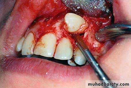 Impaction