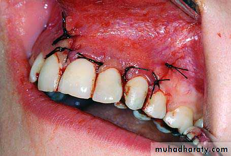 Impaction