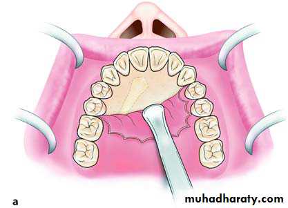 Impaction
