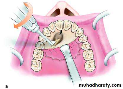 Impaction