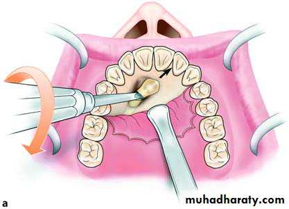 Impaction