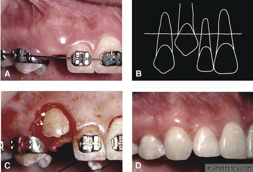 Impaction