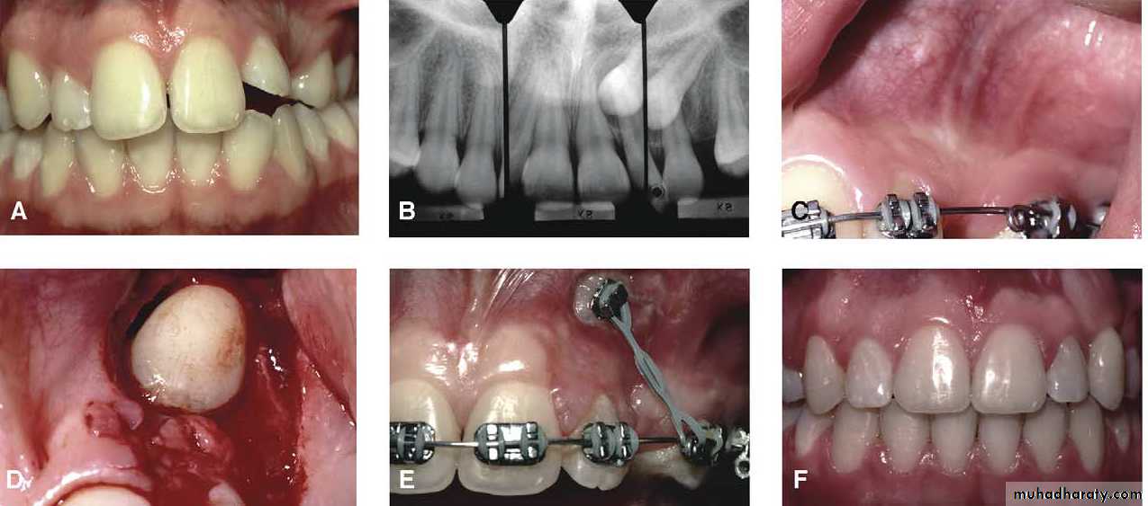 Impaction