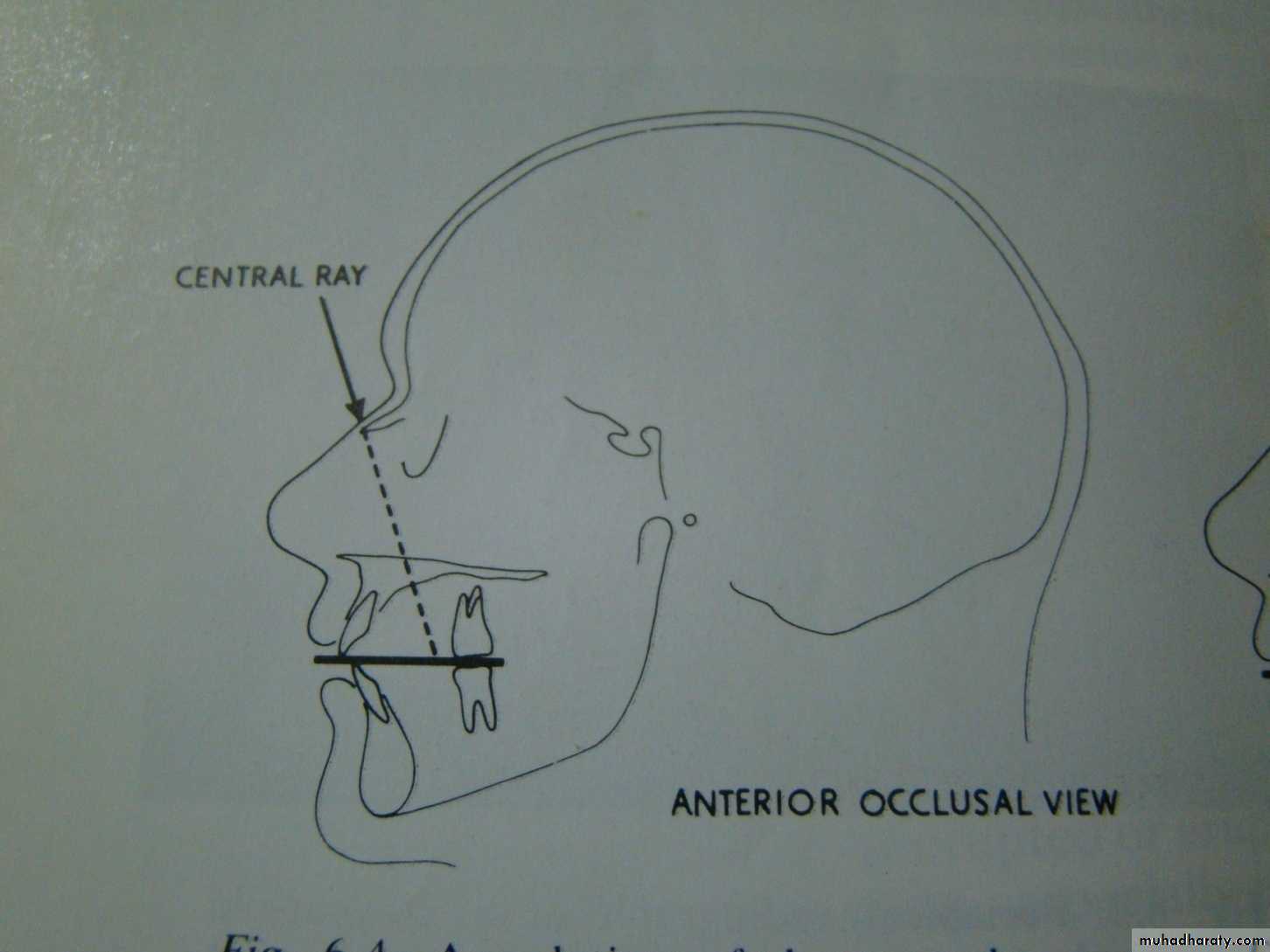 Impaction