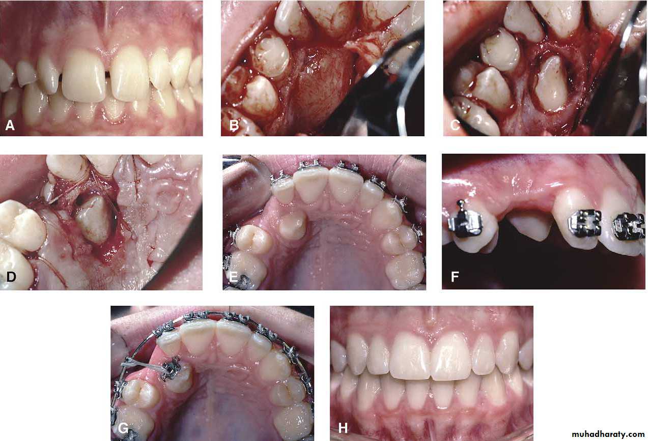 Impaction