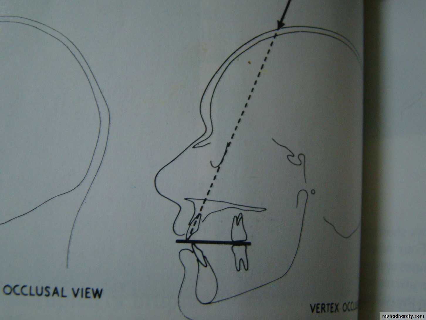 Impaction