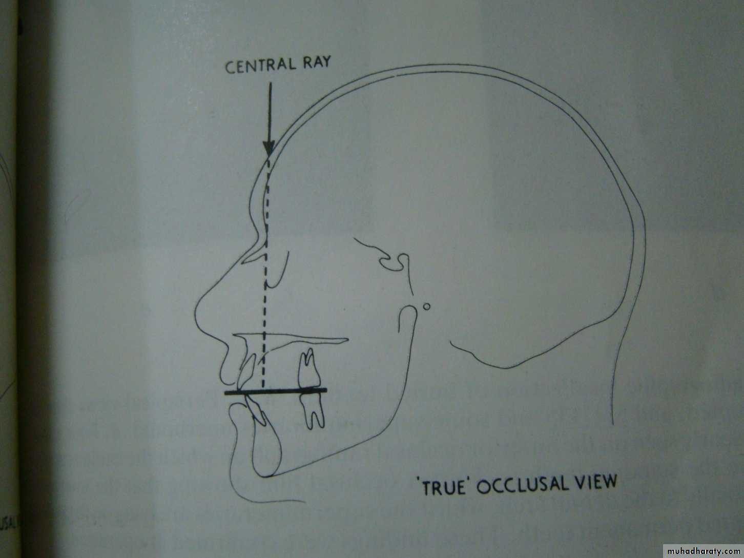 Impaction