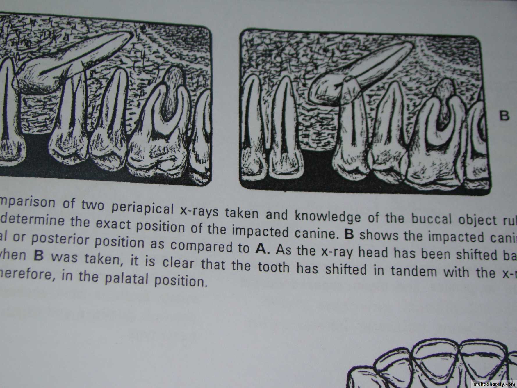 Impaction