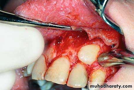 Impaction