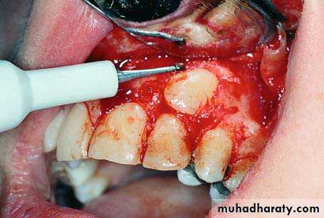 Impaction