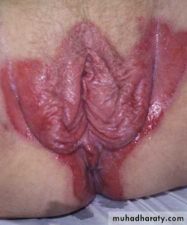 Psoriasis