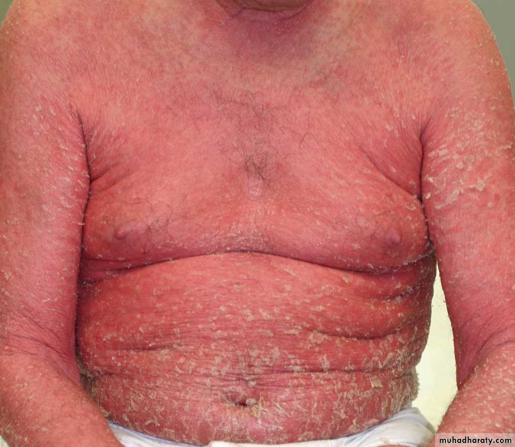 Psoriasis