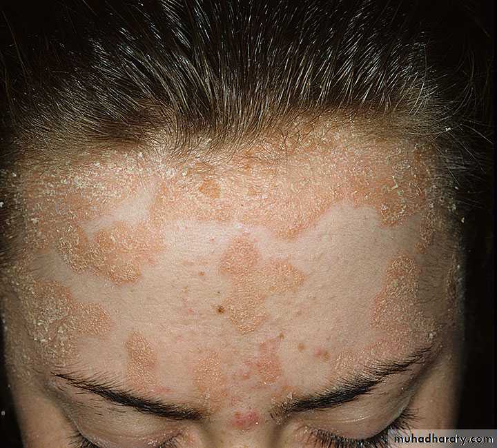 Psoriasis