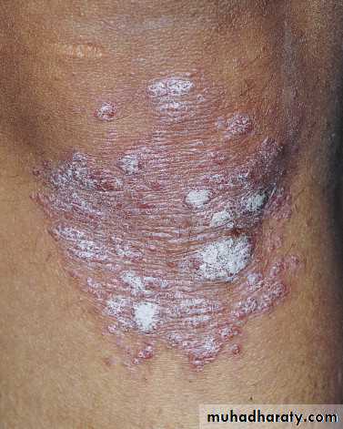 Psoriasis