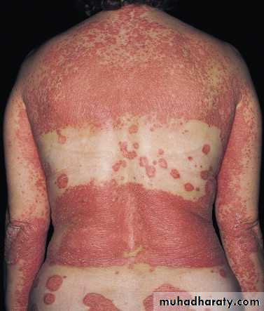 Psoriasis