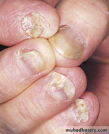 Psoriasis