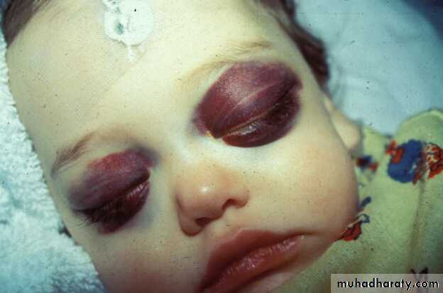 PEDIATRIC ONCOLOGY