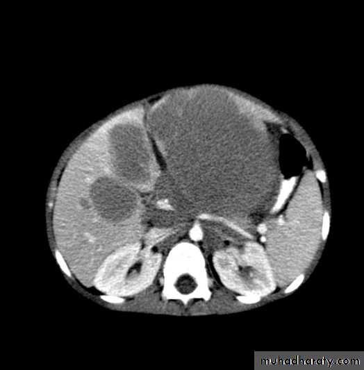 PEDIATRIC ONCOLOGY