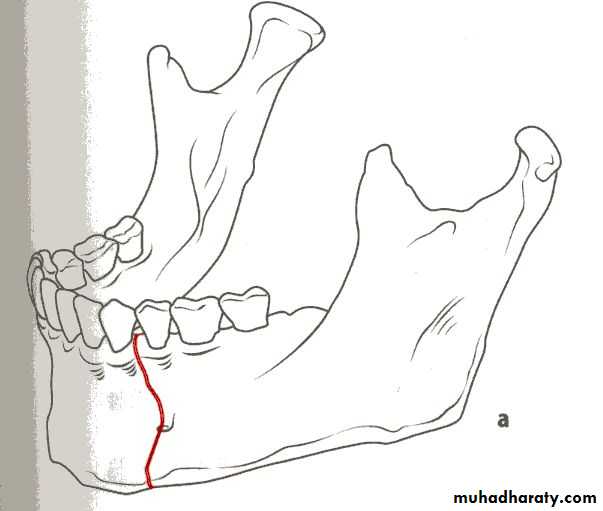 Facial fractures
