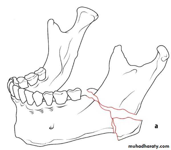 Facial fractures
