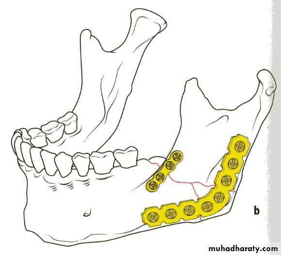 Facial fractures
