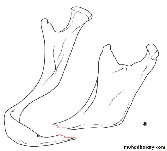Facial fractures