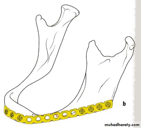Facial fractures