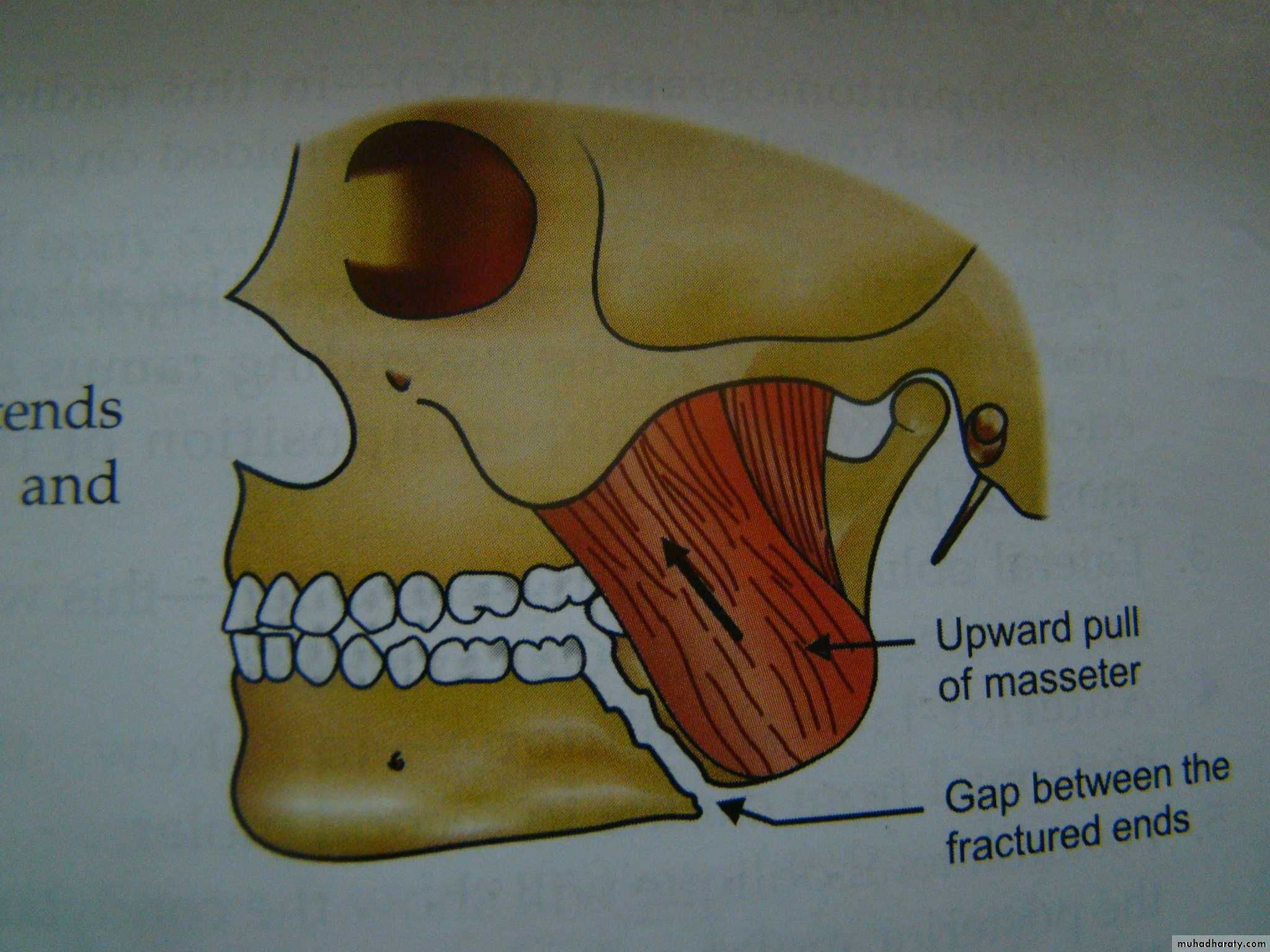 Facial fractures