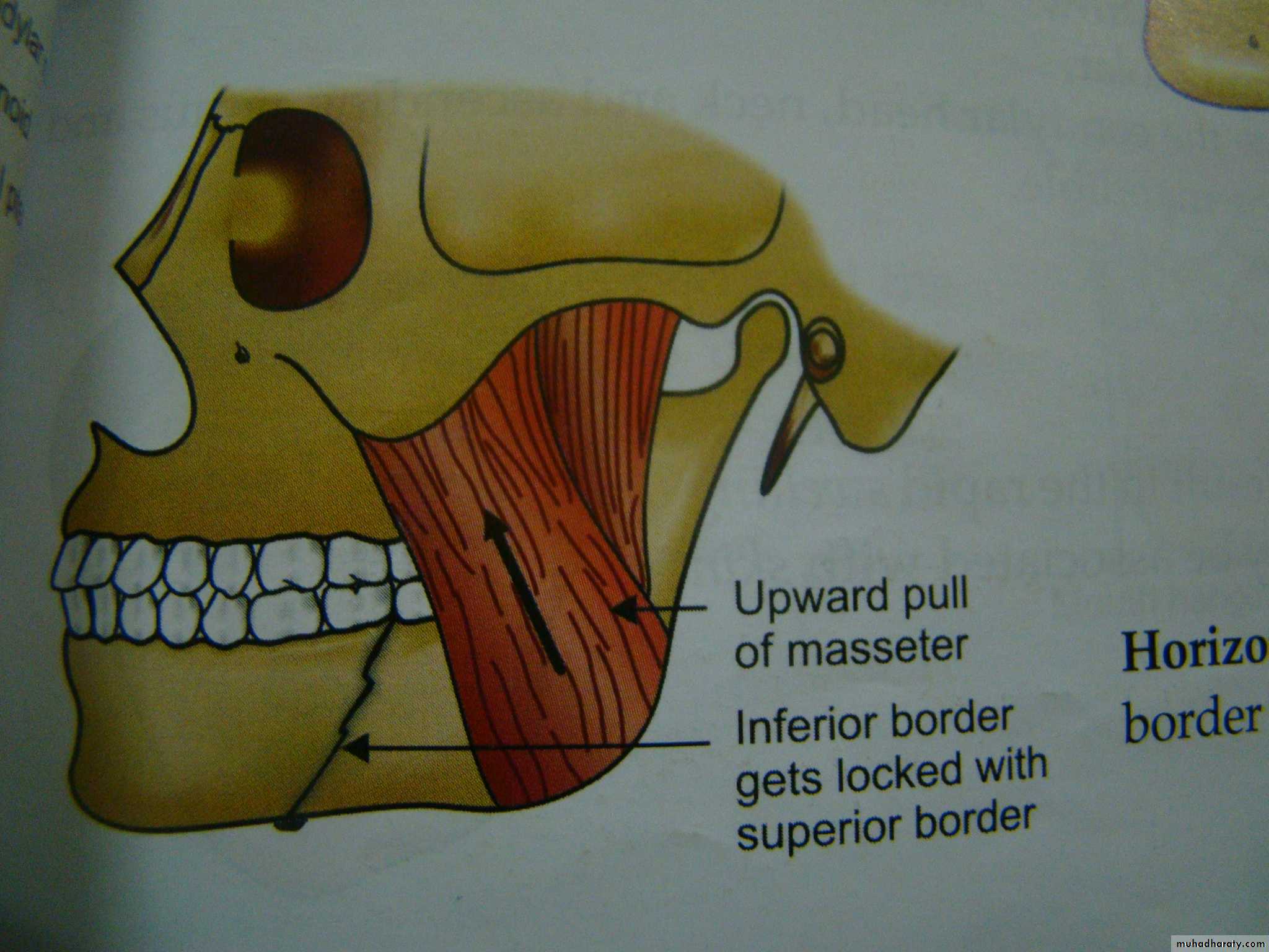 Facial fractures