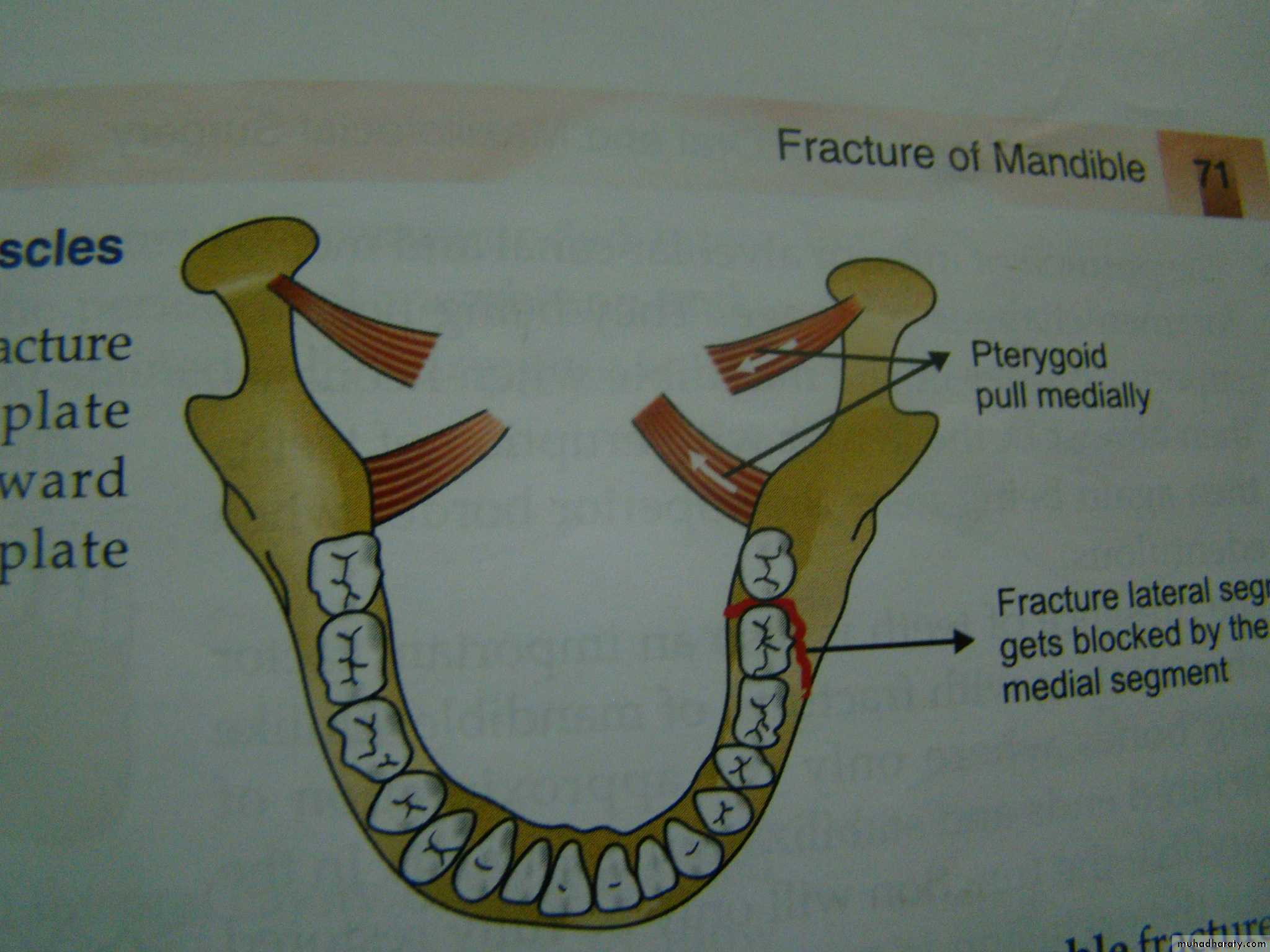 Facial fractures