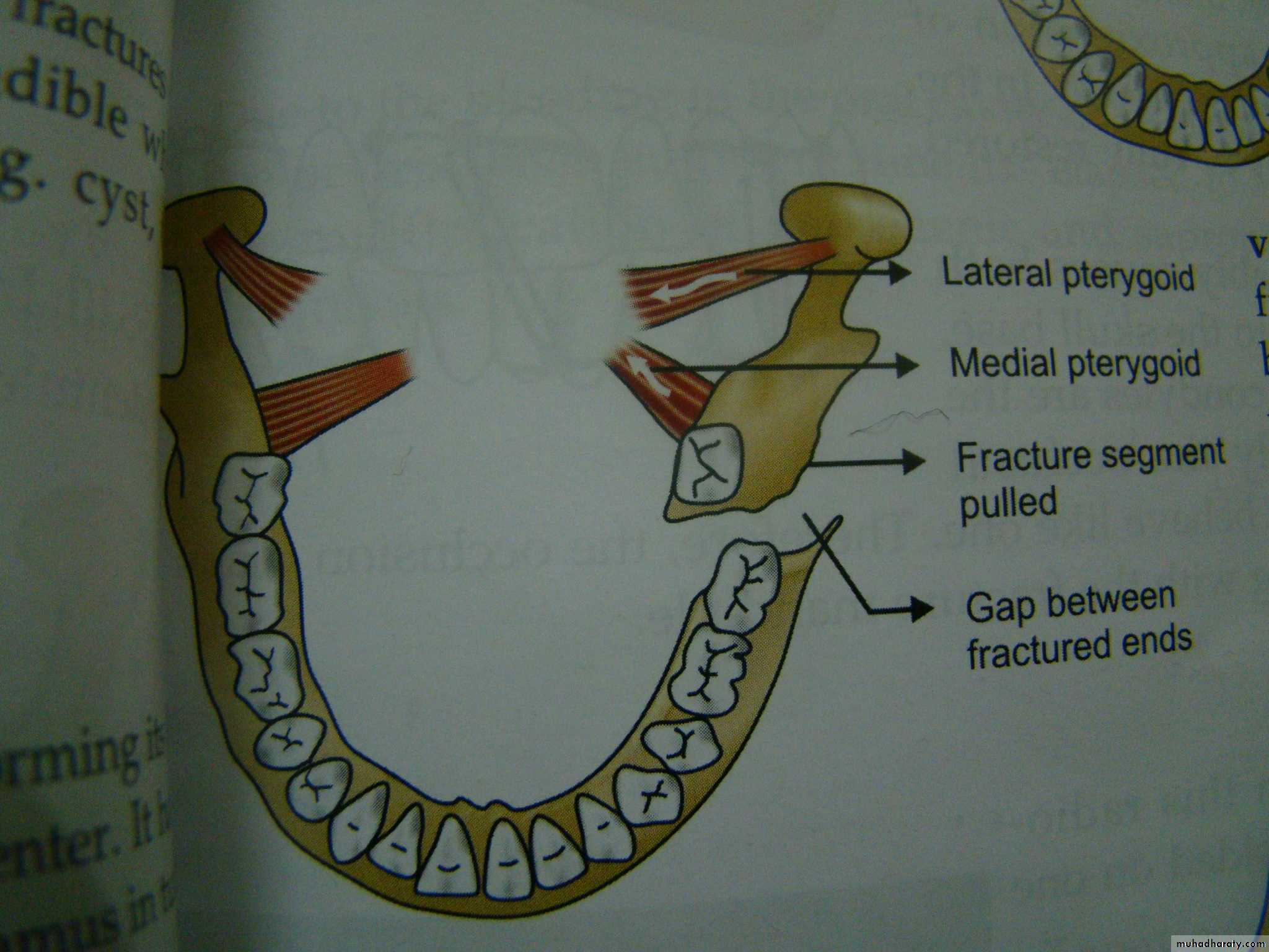 Facial fractures