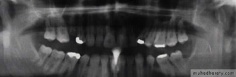 Facial fractures