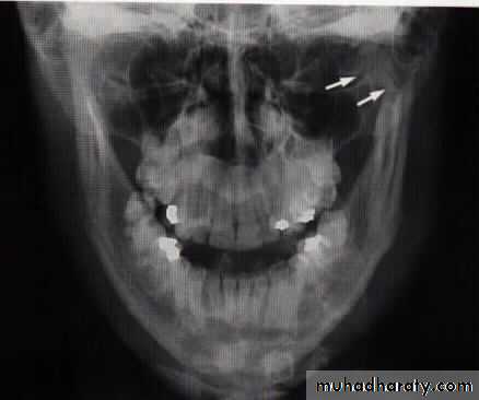 Facial fractures