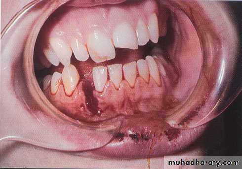 Facial fractures