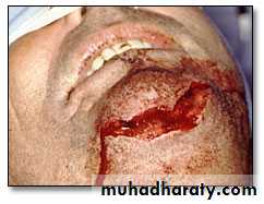 Facial fractures