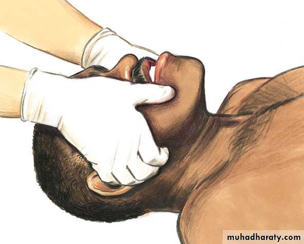 Facial fractures