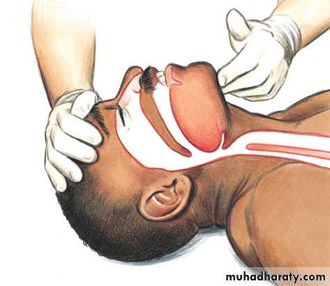 Facial fractures