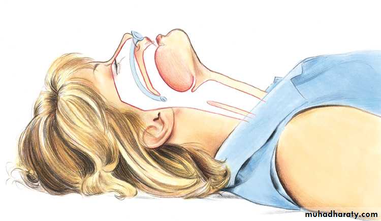 Facial fractures