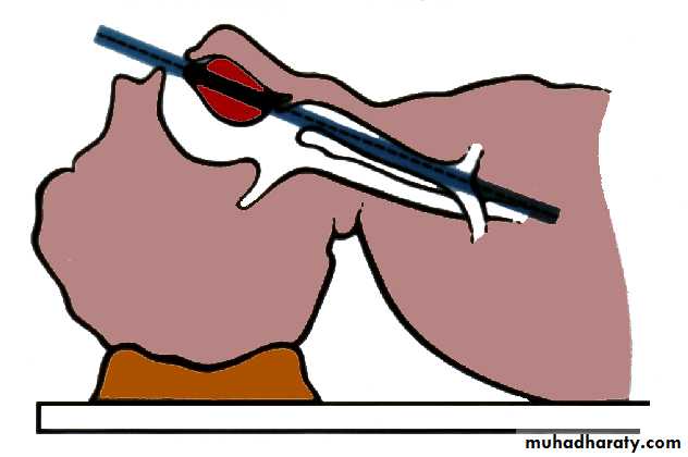Facial fractures