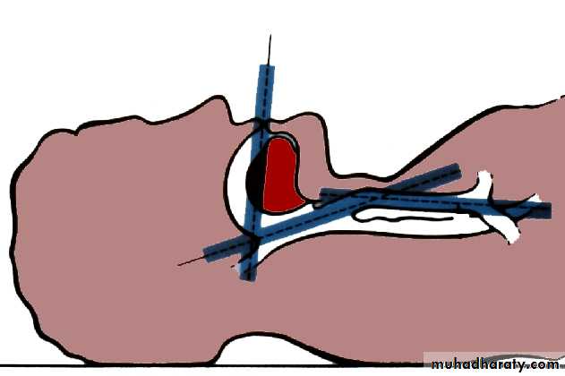 Facial fractures