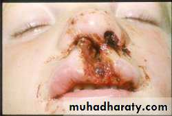 Facial fractures