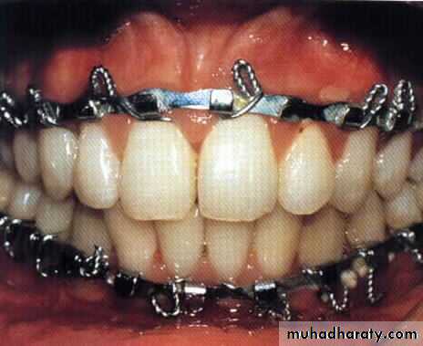 Facial fractures