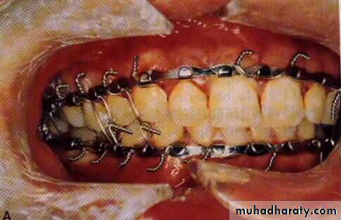 Facial fractures