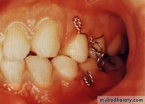 Facial fractures