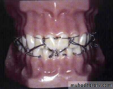 Facial fractures