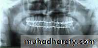 Facial fractures