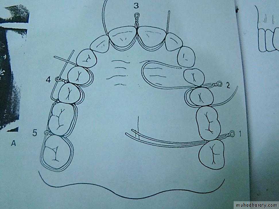 Facial fractures