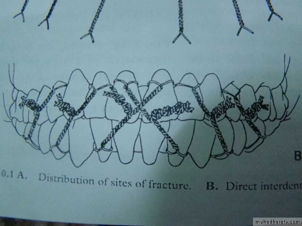 Facial fractures