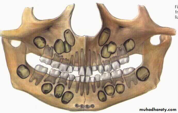 Facial fractures